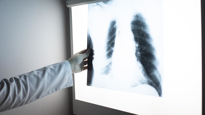 Akciğer kanseri, tüm kanser ölümlerinin yüzde 25'ini oluşturuyor